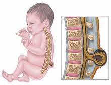 расщелина позвоночника у новорожденного