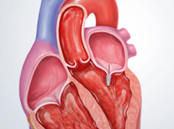 искусственные клапаны сердца