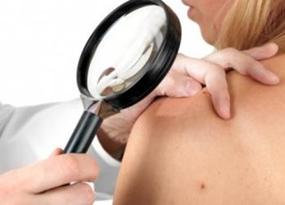Злокачественная патология кожи – Меланома