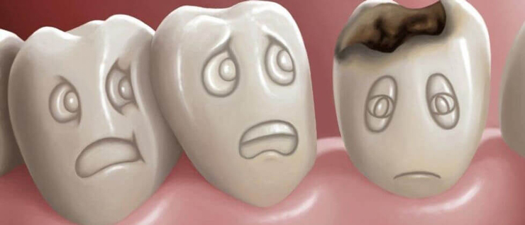  кариес «заразен» и может перейти на соседние зубы