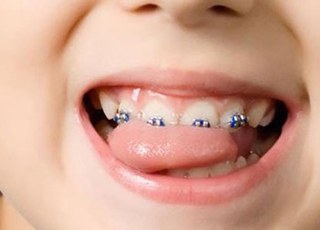 Как избежать брекетов для ребёнка